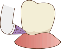 1.歯と歯の間の清掃をします。