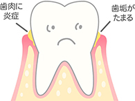 [進行度1] 歯茎がはれ、出血する