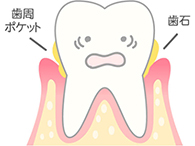 [進行度2] 口臭を感じるようになる