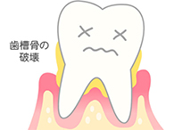 [進行度3] 歯がぐらついてくる